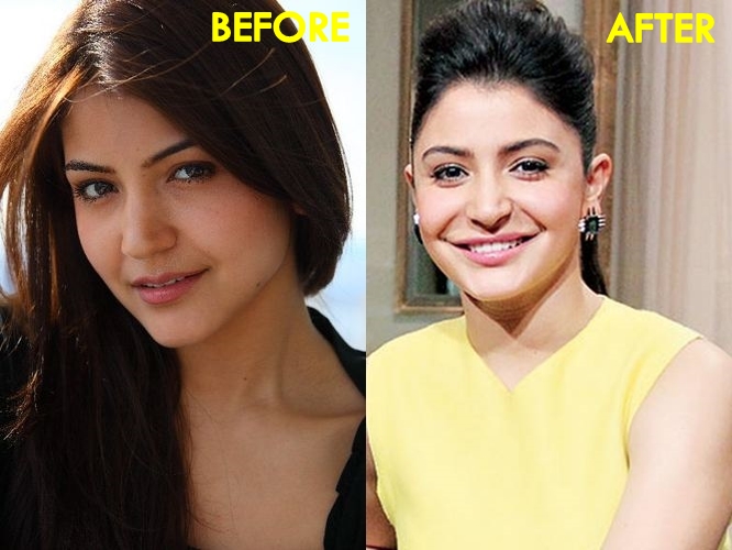 Anushka Sharma-Before & After