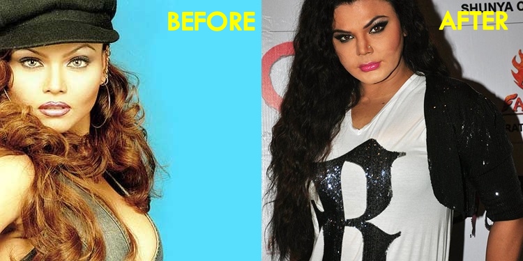 Rakhi Sawant- Before & After