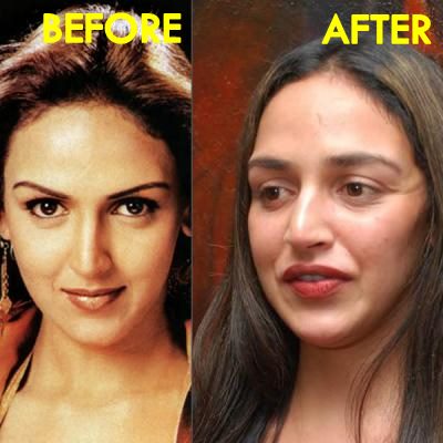 10 Bollywood Celebrities With Worst Plastic Surgeries